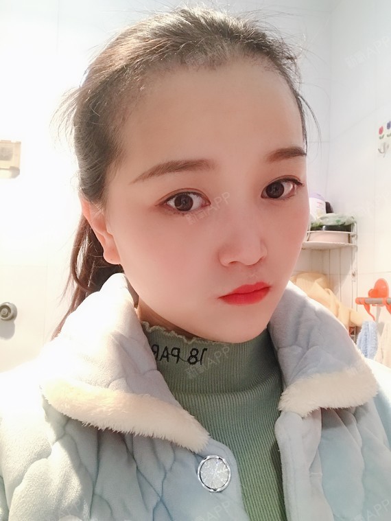 术后第50天