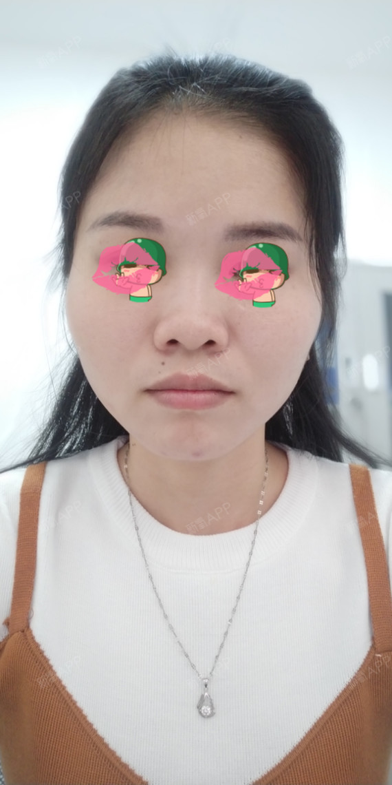玻尿酸隆鼻好不好_效果图_阿德莱德玻尿酸隆鼻术后第17天_新氧美容