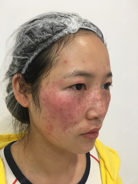 皮秒激光