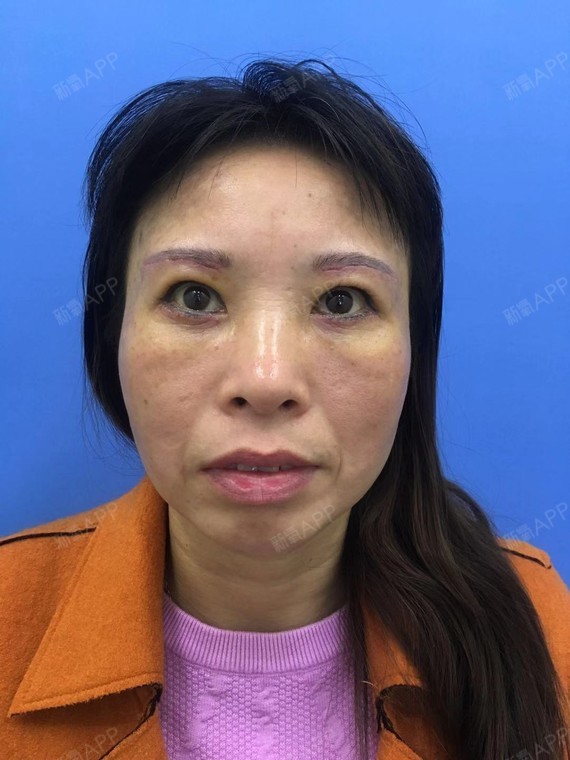 吉首内切去眼袋好不好_效果图_氧气npz9261内切去眼袋术后第7天_新氧