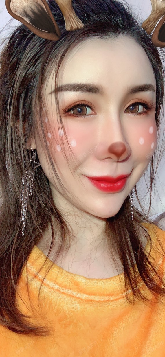 【青岛华颜美-玻尿酸垫下巴术后第154天】