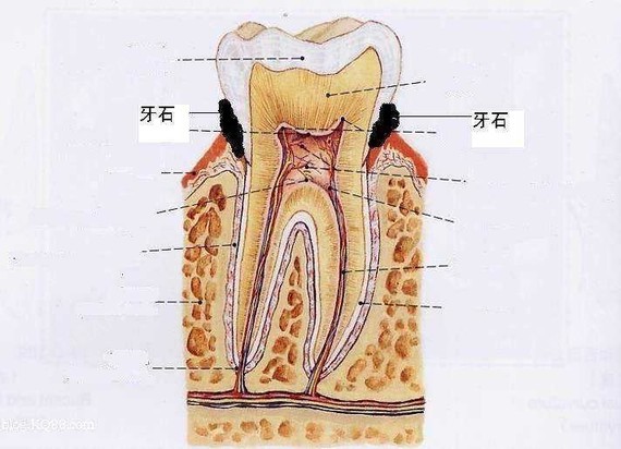 牙结石图片形成原因图片