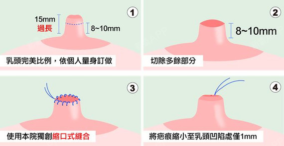 乳头缩小术对比图片