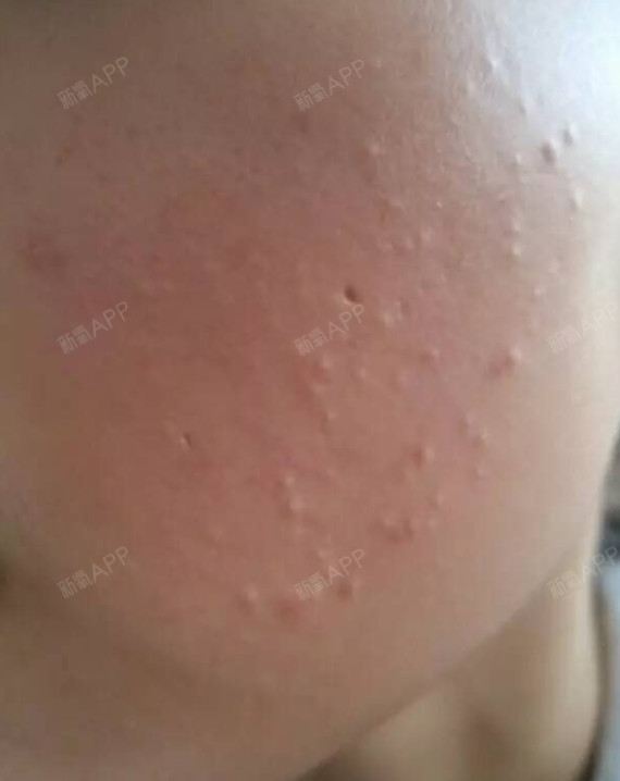 闭合性粉刺鸡皮疙瘩(鸡皮疙瘩粉刺有啥方法)