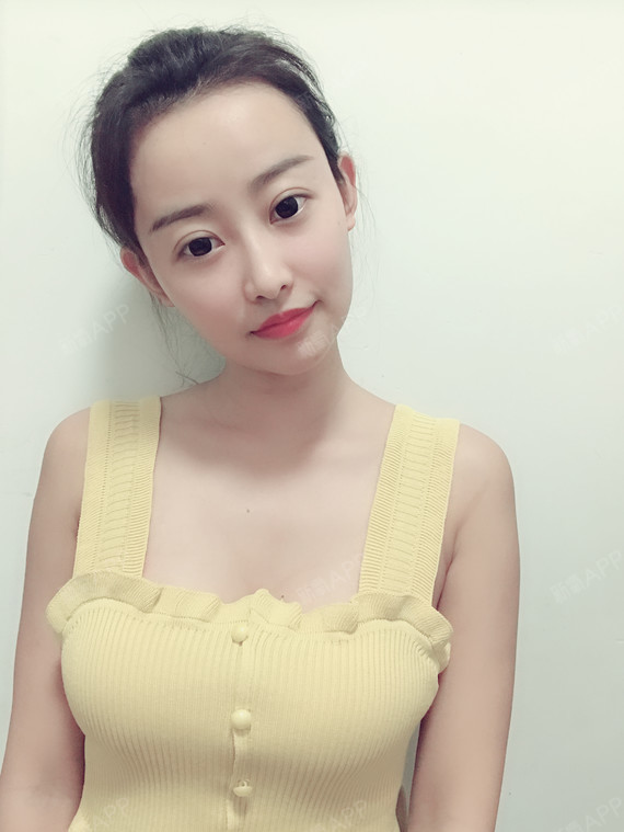 重庆自体脂肪隆胸好不好_效果图_秦达达自体脂肪隆胸术后第189天_新氧