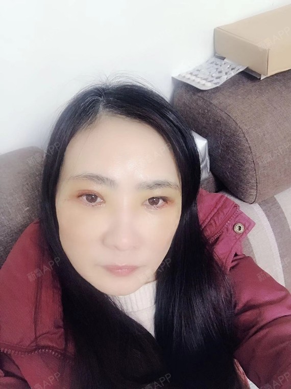 【红颜拜博外切眼袋 提眉第3天】今天眼部还有点不舒_圈子-新氧美容