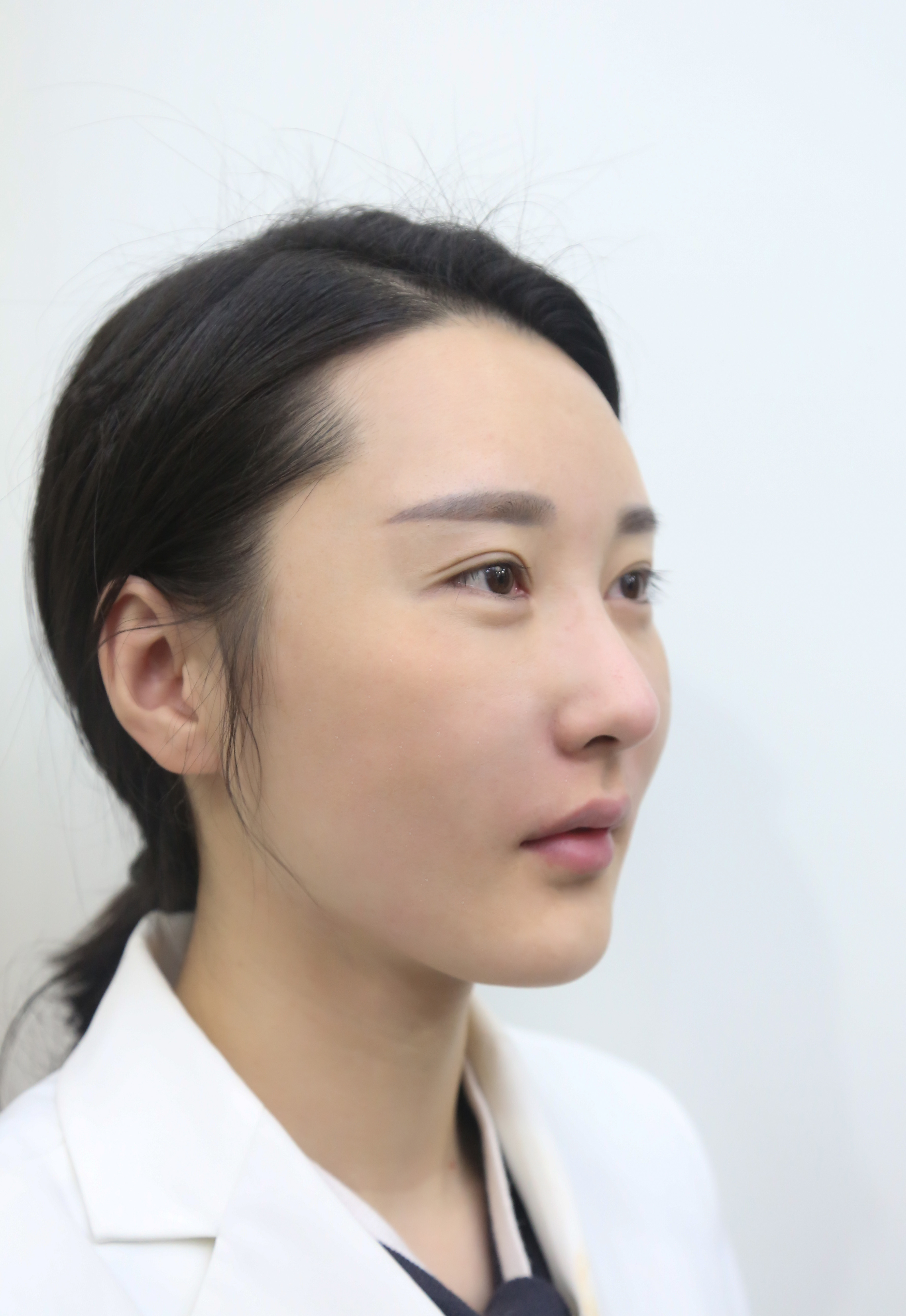 玻尿酸去法令纹第0天