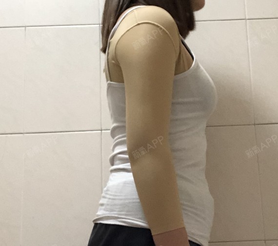 哈尔滨吸脂瘦手臂好不好_效果图_一个小可爱蹦蹦哒哒吸脂瘦手臂术后第