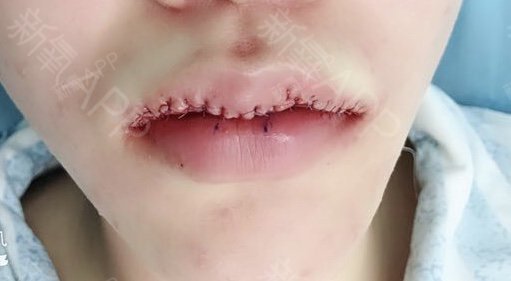 今天终于改了上下唇不对称无唇峰问题,虽