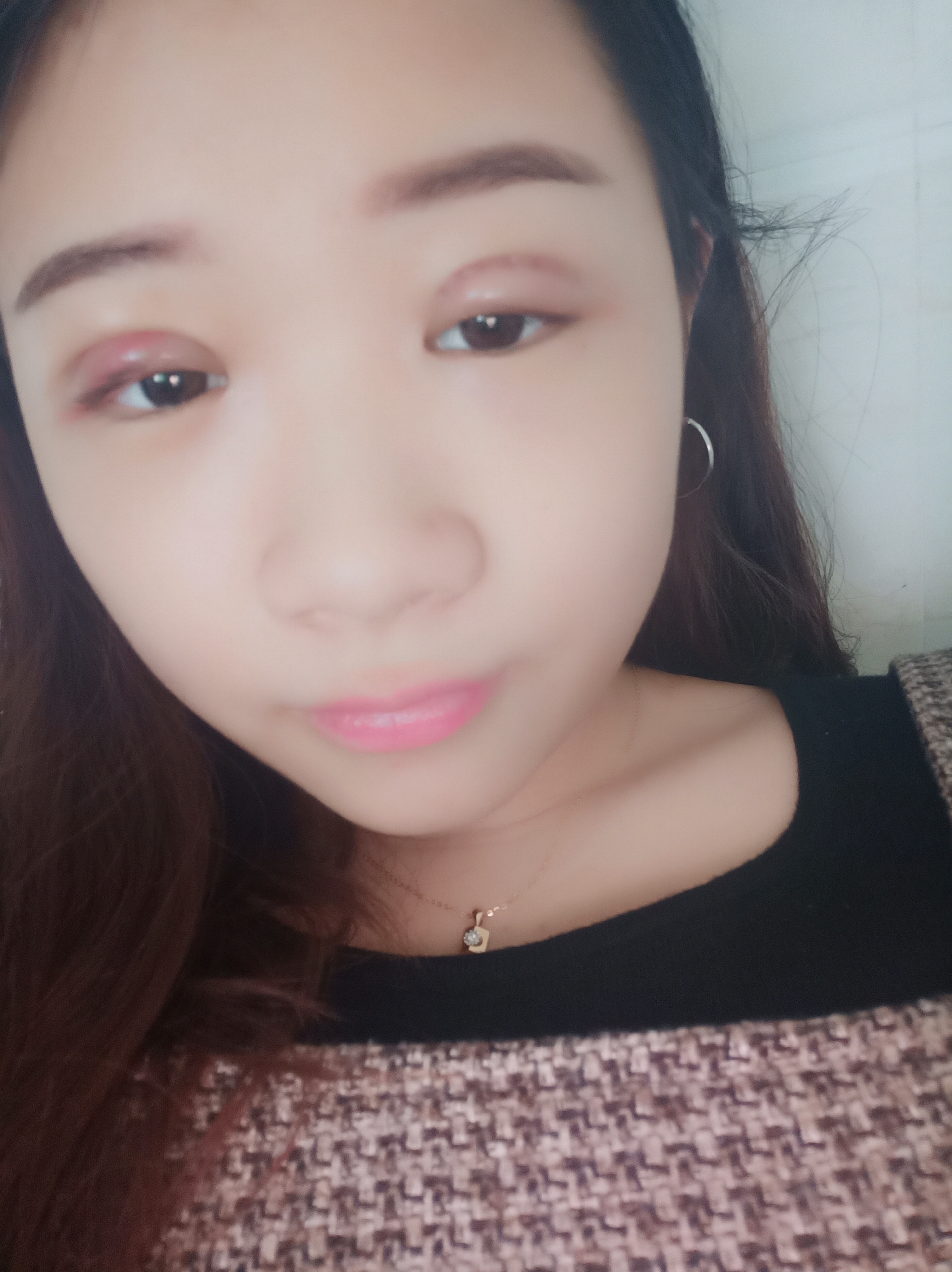 恢复中.眼睛形态还是不太明显,看图片能看出来还是肿肿的.