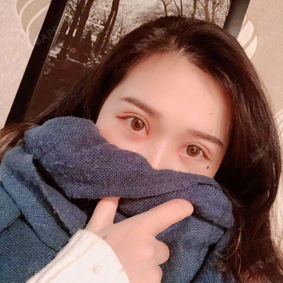 双眼皮一般在6mm到8mm之间7815我选择了7mm,_圈子-新氧美容整形