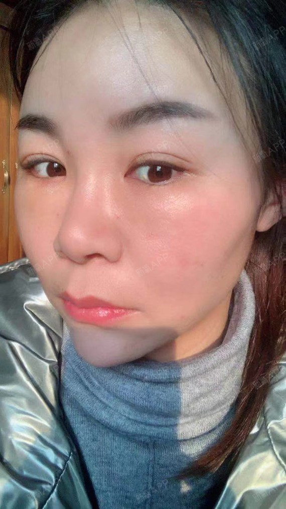 眼部 | 眼袋 | 术后当自强 | 济南同城 | 眼部抗衰 | 眶隔脂肪释放