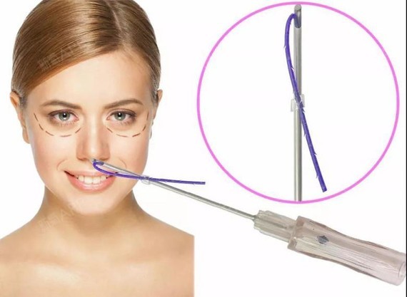 线雕隆鼻出现的一些问题每当科普线雕隆鼻的一些风险时_圈子-新氧美容