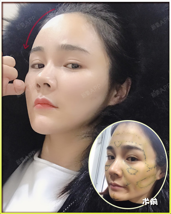 自体脂肪全脸填充看起来很假?专业医生这样避免!