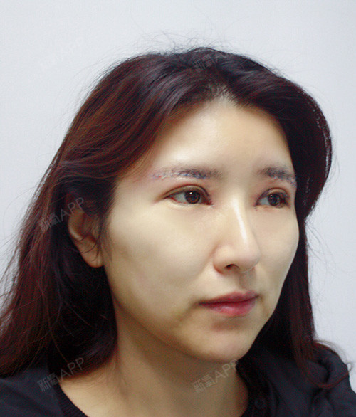 上海切眉术好不好_效果图_meetfriends切眉术术后第0天_新氧美容整形