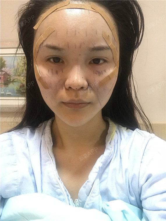 蛋白填充脸会硬吗_蛋白填充面部能维持胶原自体嘛_自体胶原蛋白填充面部能维持多久
