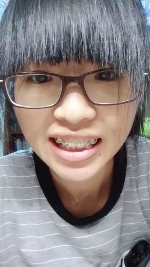 金属托槽矫正好不好_效果图_氧气zahv5金属托槽矫正术后第9天_新氧