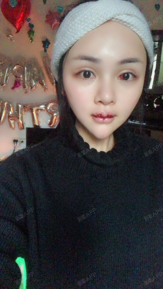 氧气zrtxe厚唇改薄第3天美丽日记