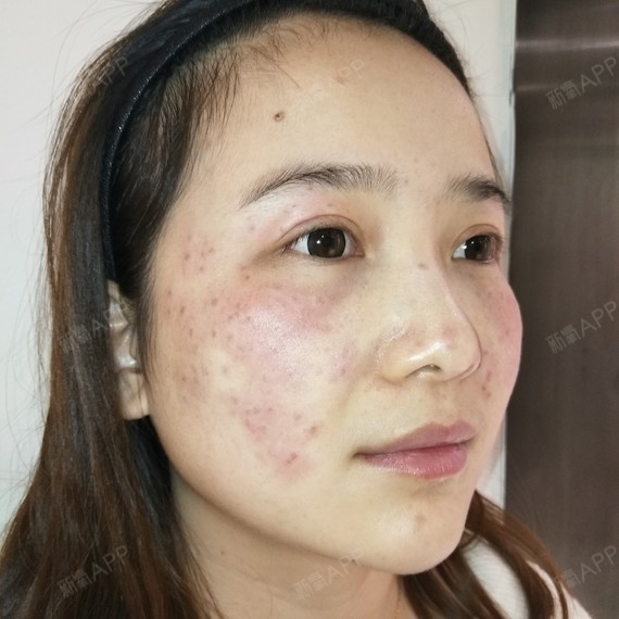 初次体验调q激光祛斑的体验感~很奇妙[:136]看_圈子-新氧美容整形