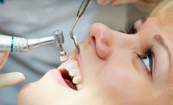 学名叫做龈上洁治术,俗称洗牙,是一种简单粗暴的物理