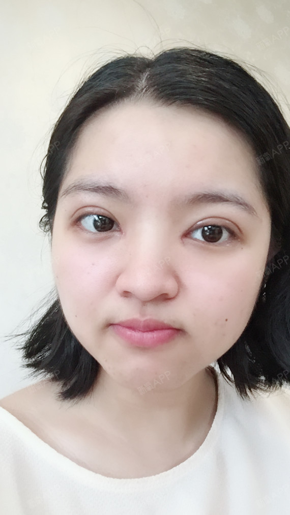 今天是我术后第10天的样子,眼睛肉眼已经完全看不到_圈子-新氧美容