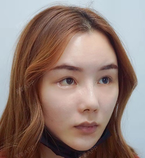 开外眼角 | 术后当自强 | 上海同城 | 赤峰同城 | 下眼睑 | 下眼下至