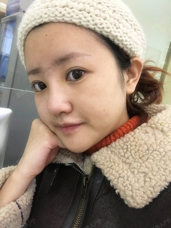 新氧- 一路向北走 | 鼻部 | 隆鼻 | 膨体隆鼻 | 术后当自强 | 武汉