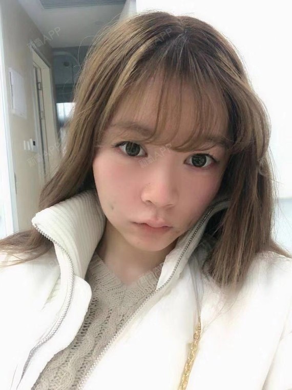 双侧埋线酒窝术后当天效果.