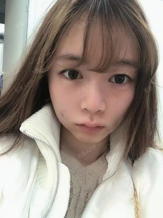 双侧埋线酒窝术后当天效果.