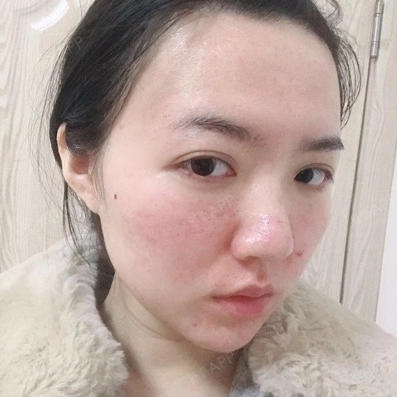 射频微针