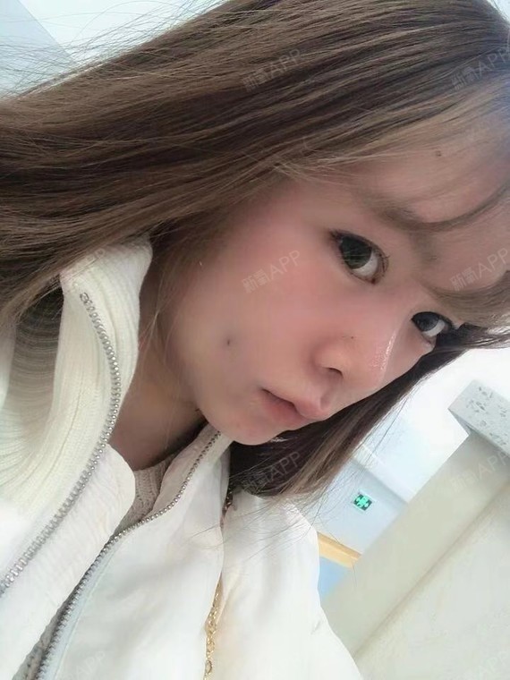 双侧埋线酒窝术后当天效果.