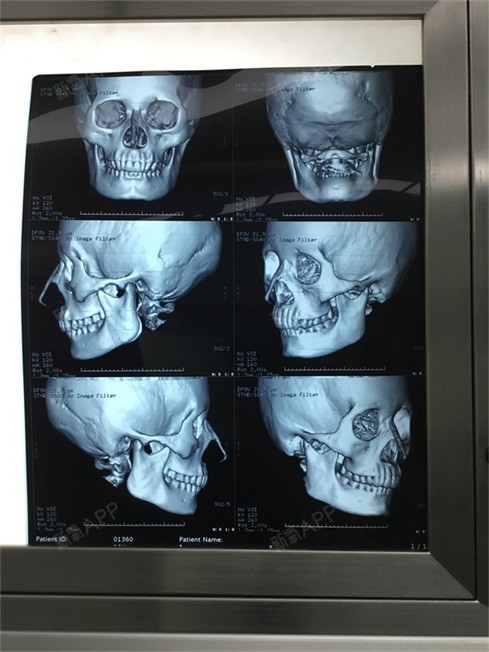 说王珍祥院长有时间,于是当天就去院长办公室面诊了,还拍了头部ct片