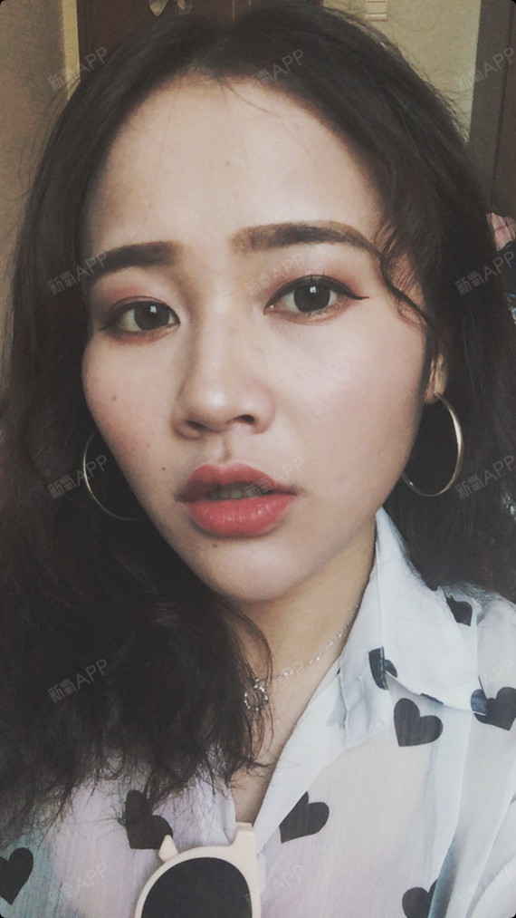 合肥厚唇改薄好不好_效果图_烨烨i厚唇改薄术后第249天_新氧美容整形