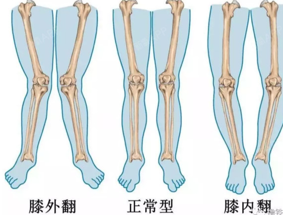 改善胫骨内旋图片