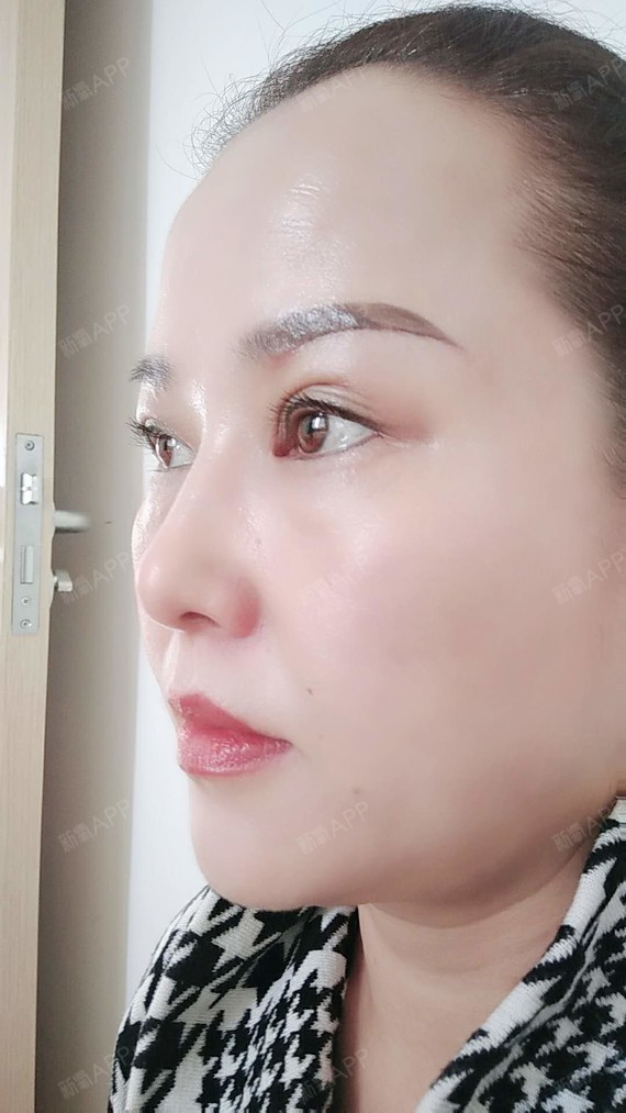 切眉术好不好_效果图_氧气1ug4e4b切眉术术后第24天_新氧美容整形