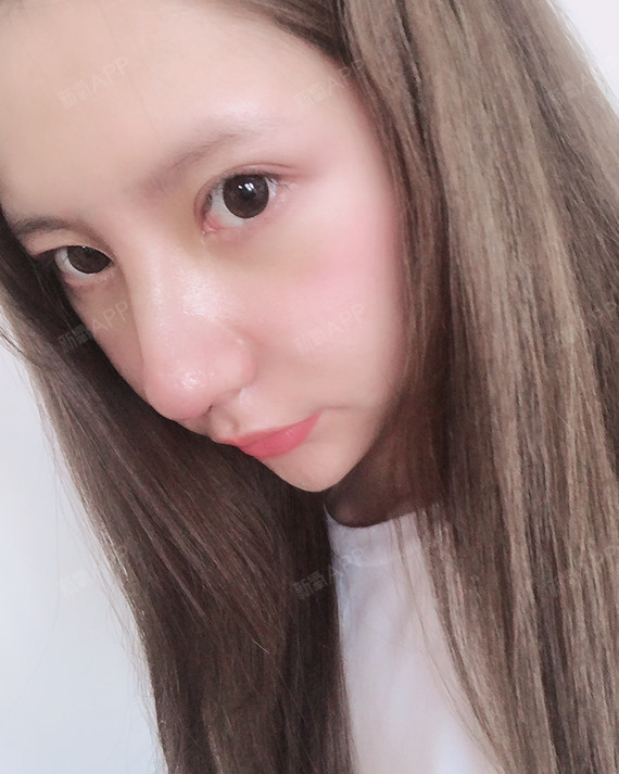 肋软骨隆鼻 术后第10天