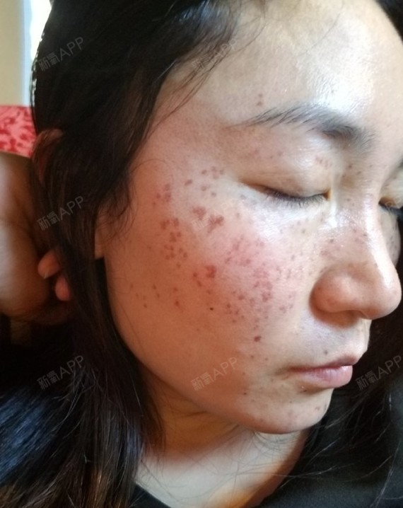 【深圳和美[:66]超皮秒第2次4天】反上来的黑色_圈子-新氧美容整形