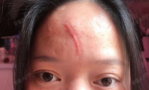这个额头上的疤真的是让我哭,剪刘海又不好看,露出来