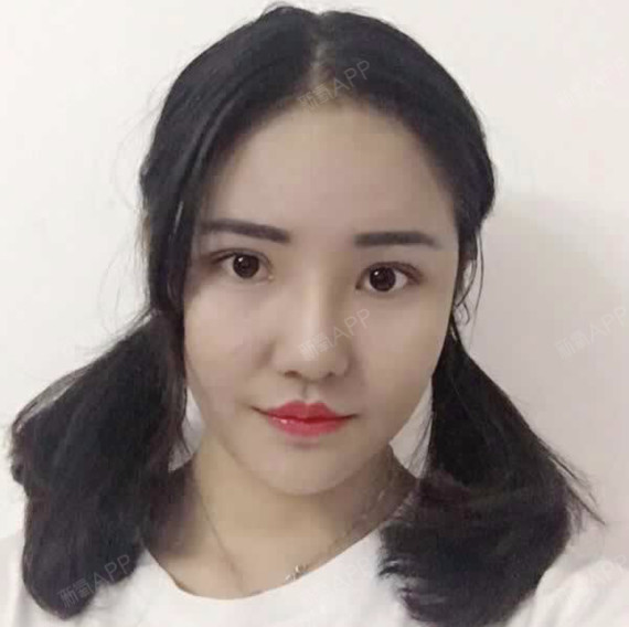 深圳玻尿酸全脸填充好不好_效果图_氧气zrlpe玻尿酸全脸填充术后第24