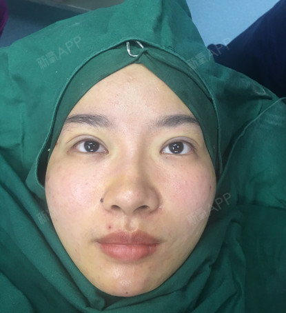 做的双眼皮能自然到什么程度#拥有一双好看的眼睛第_圈子-新氧美容