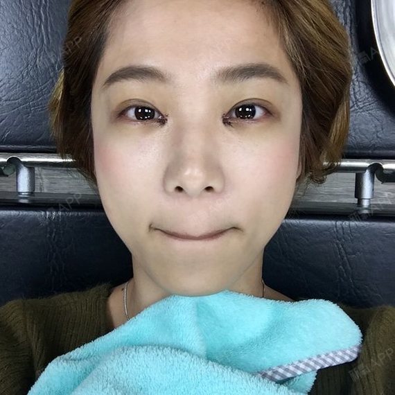 先来张正面自拍看看其实开眼角并不会让眼睛变大变圆啦_圈子-新氧美容