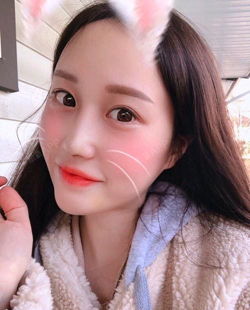 隆鼻之前我鼻子往下走有点驼峰 鹰钩鼻的感觉不是那么的灵气.