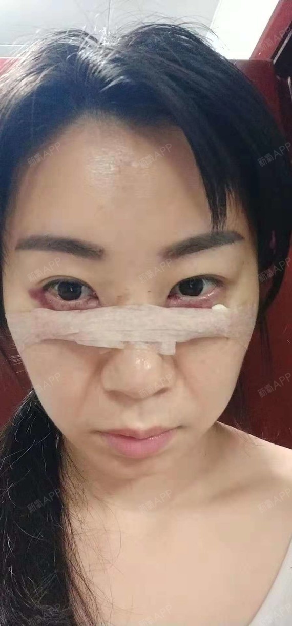 广州内切去眼袋好不好_效果图_曾经的微笑2008内切去眼袋术后第1天