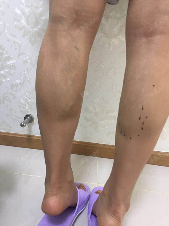 注射瘦小腿好不好_效果图_田螺姑娘o注射瘦小腿术后第1天_新氧美容