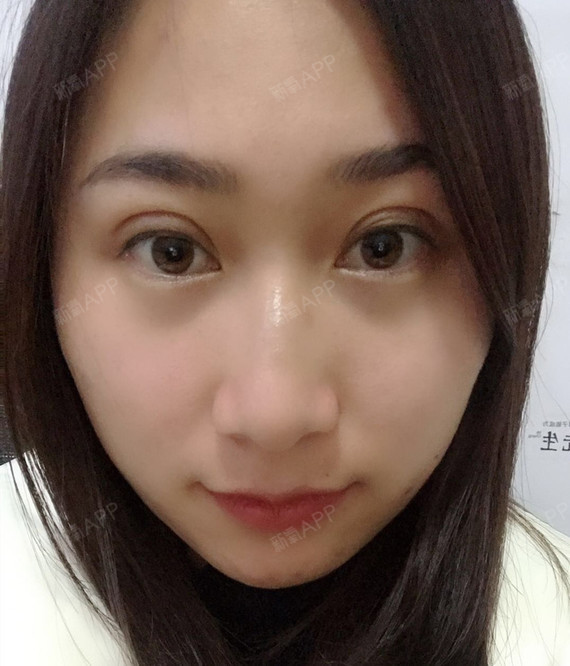 今天是做双眼皮的第10天,拆完线之后眼睛慢慢消肿了_圈子-新氧美容