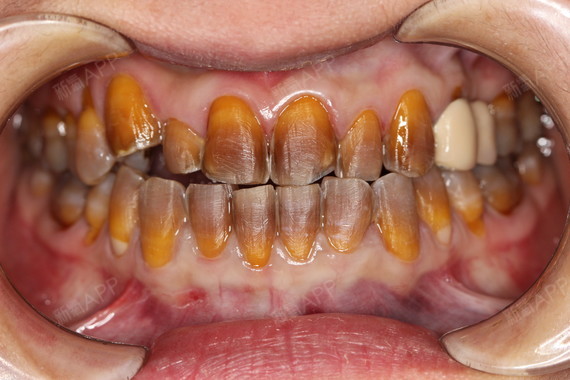 我的牙齿很不好看,门牙不整齐,颜色也暗黄,感觉张开