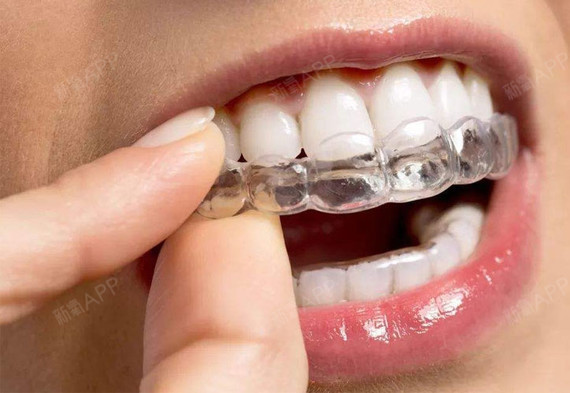 牙齿保持器一般戴多久图片