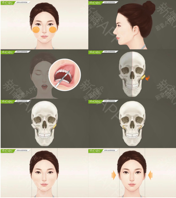 顴骨&顴弓 【3d旋轉顴骨縮小術】