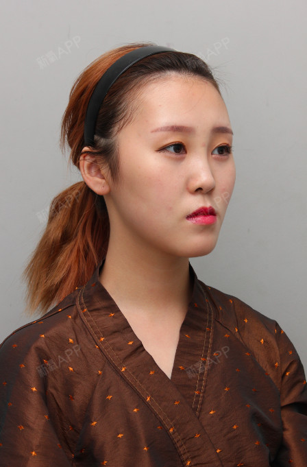 下颚前突/地包天好不好_效果图_打卤面99下颚前突/地包天术后第0天