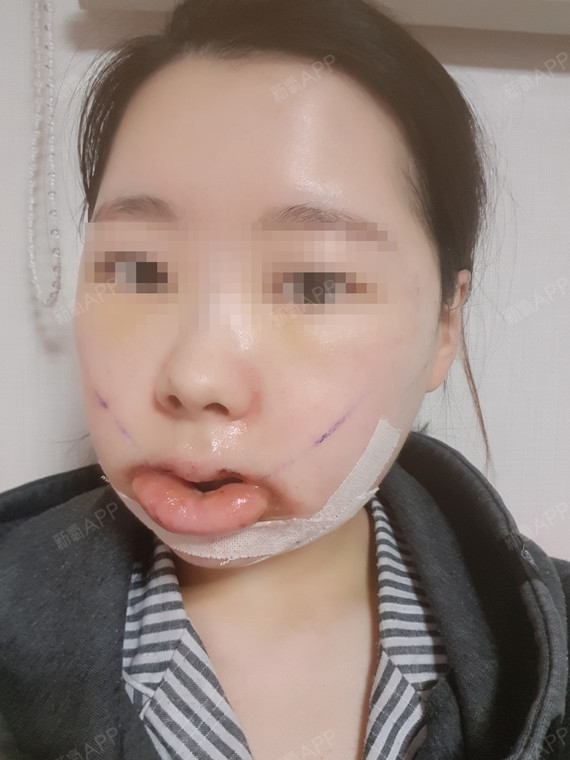 上下颚手术/突嘴矫正好不好_效果图_氧气zs81r上下颚手术/突嘴矫正术